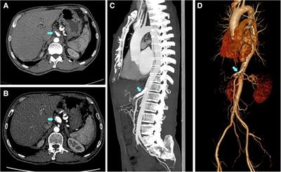 General features, management strategies, and outcomes of symptomatic spontaneous isolated celiac artery dissection